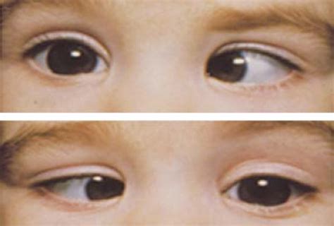 Strabismus | Ento Key