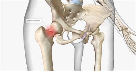 Une Fracture Du Col Du Fémur Est Un Type De Fracture De La Hanche Qui