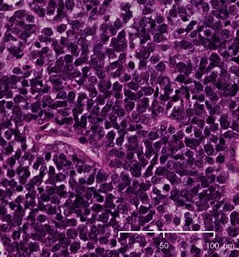 Pathological Examination Of The Resected Specimen Hematoxylin And