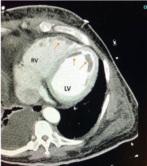 CT Angiogram Imaging Of The Chest Showing Filling Defects Along Right