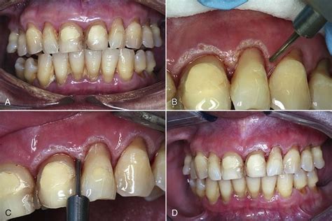 5 Regenerative Laser Periodontal Therapy Pocket Dentistry