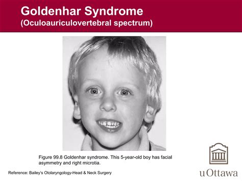 Craniofacial Anomalies Ppt
