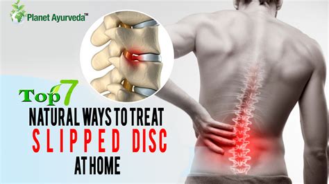 Top Natural Ways To Treat Slipped Disc At Home