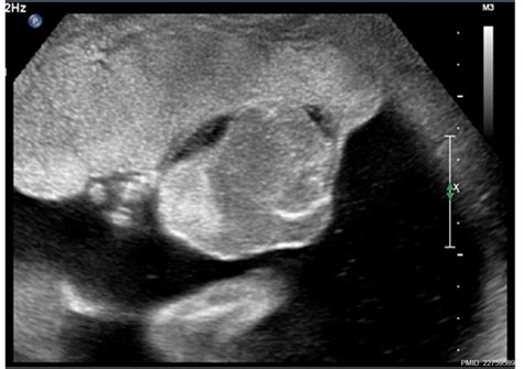 Fileplacental Chorioangioma Ultrasound 01 Embryology