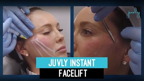 Non Surgical Facelift Procedure With Dr Justin Face Lift Before And