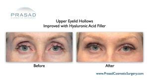 Can Upper Blepharoplasty Go Wrong Dr Prasad Blog