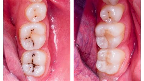 Composite Fillings May Be More Difficult To Set Than Porcelain Ones