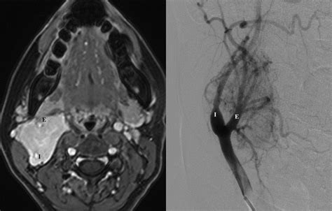 Paraganglioma | NucsRadiology.com