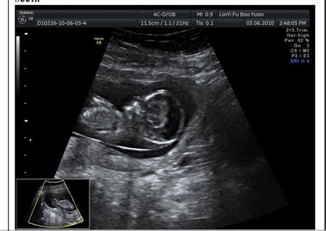 Hydranencephaly Ultrasound