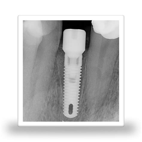 Servicio de identificación de implantes dentales basado en la IA