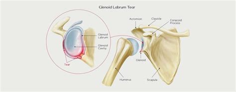 Shoulder Labral Tear Motus Physical Therapy