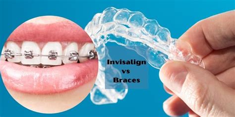 Invisalign Vs Braces Know What Is Best For You