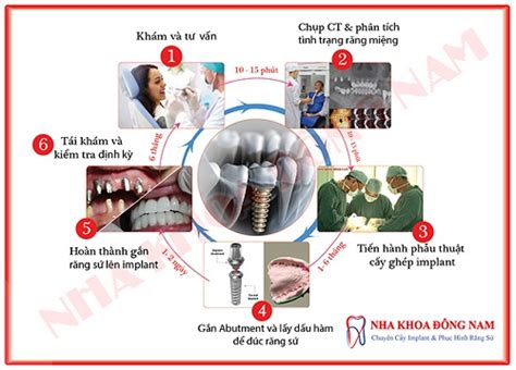 Quy Trình Cắm Ghép Răng Implant Đúng Chuẩn Lãm Sách