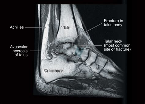 Avascular Necrosis Of The Talus Dr Bijan 4 Feet