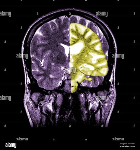Normal coronal mri brain hi-res stock photography and images - Alamy