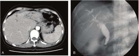 A, Computed tomography (CT) scan showed left liver atrophy with IHD... | Download Scientific Diagram