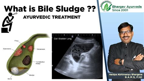 What Is Bile Sludge Gallbladder Sludge Gallbladder Sludge