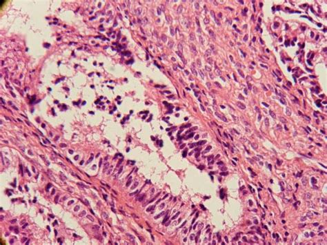 Non Atypical Glandular Endometrial Hyperplasia Against Inflammatory Download Scientific Diagram