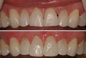 What Is Dental Bonding Steps Uses Benefits Explained