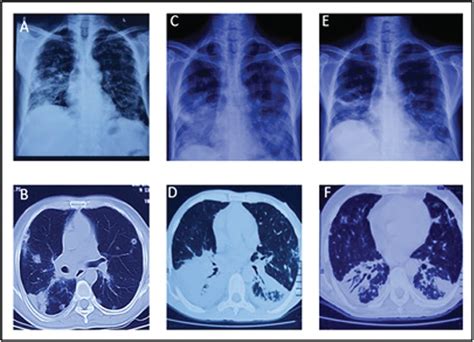 Immunoglobulin G4 Related Disease Presenting With Pulmonary The