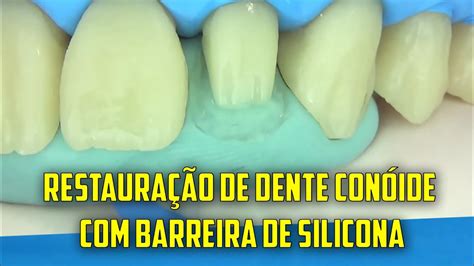 Dente Con Ide Antes E Depois Braincp