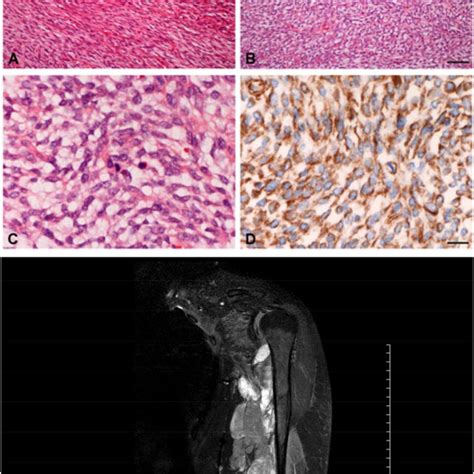 Histopathologic Grading Of Fibrosarcoma Download Table