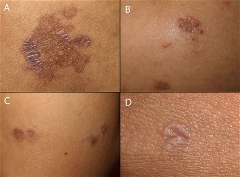 Case Of Lichen Planus With Unusual Features Bmj Case Reports