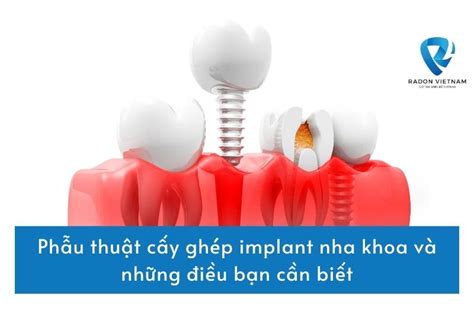 Ph U Thu T C Y Gh P Implant Nha Khoa V Nh Ng I U B N C N Bi T