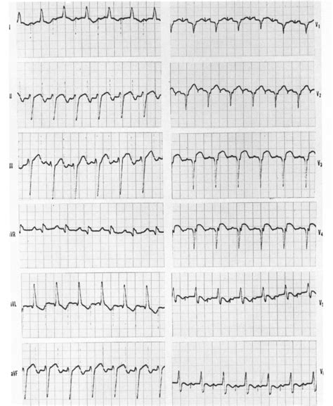 Atrial Pacing