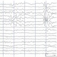 A 21 Year Old Female Patient With Refractory Epilepsy A Interictal