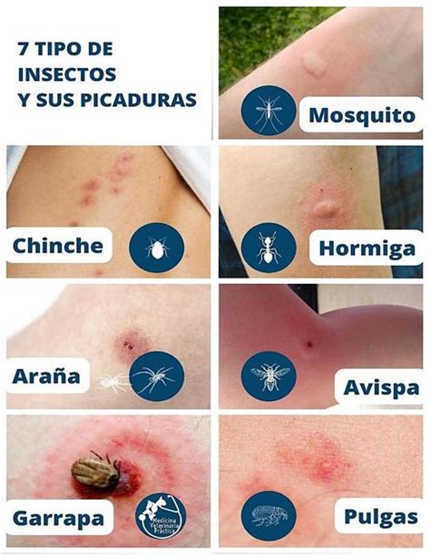 Como Reconocer Las Picaduras De Diferentes Tipos De Insectos Y Que