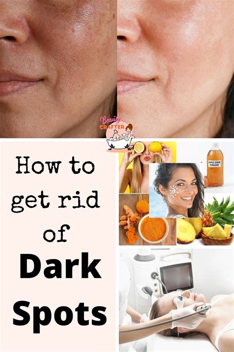 How To Get Rid Of Dark Spots Artofit