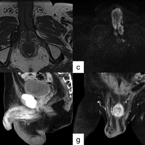 A Axial T2 Weighted Image B Axial T1 Weighted Image C D Axial