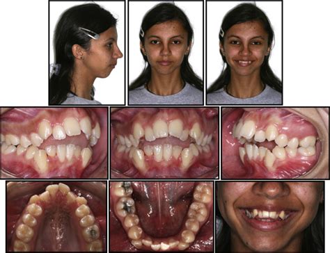 Angle Class 1 Malocclusion