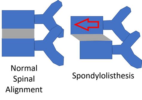 What Does Spondylolisthesis Surgery Recovery Look Like?