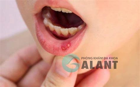 Triệu Chứng HIV Sau 1 Tháng Những Dấu Hiệu Cảnh Báo Sớm Cần Biết