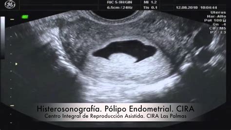 Histerosonograf A De P Lipo De Endometrio Cira Youtube