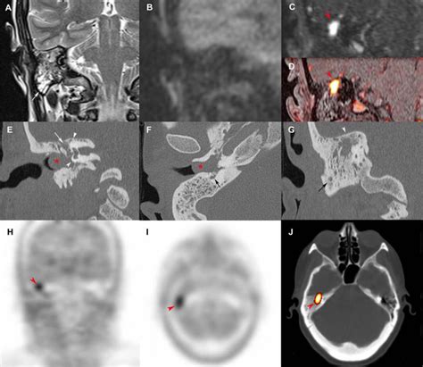 Tympanic paraganglioma in a rare attical location | Download Scientific ...