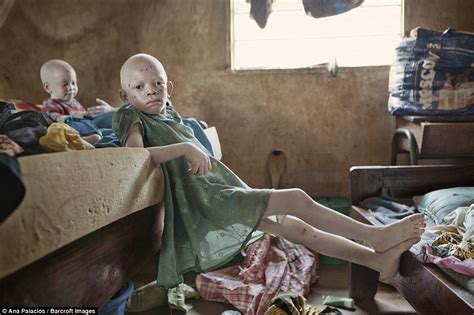 Rescue ‘fortress’ In Tanzania Protects Albinos From Human Hunters Daily Mail Online