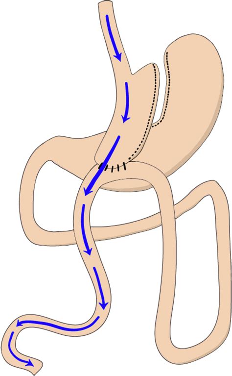 One Anastomosis Gastric Bypass Oagb Oagb Entails The Creation Of A