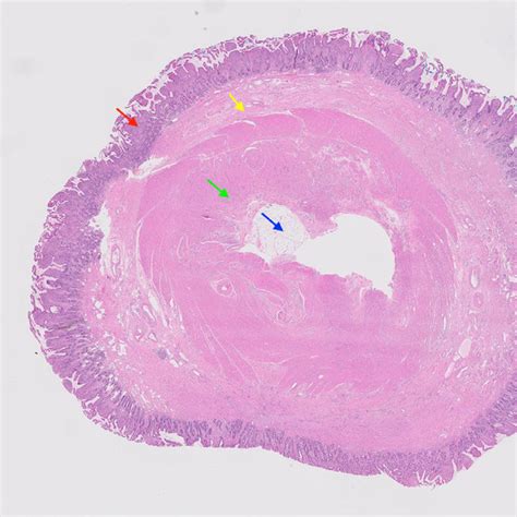 (PDF) A case report of inverted Meckel's diverticulum