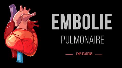 Embolie Pulmonaire Cardiologie Urgence Détails YouTube