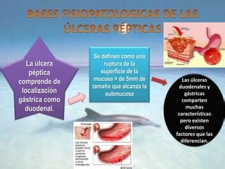 Ulcera Gastrica Y Duodenal Ppt