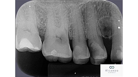 Cisto Periodontal Lateral Patologia Bucal