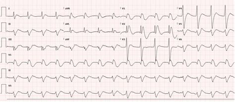 Ecg Showing Wide Complex Rhythm Consistent With Slow Ventricular