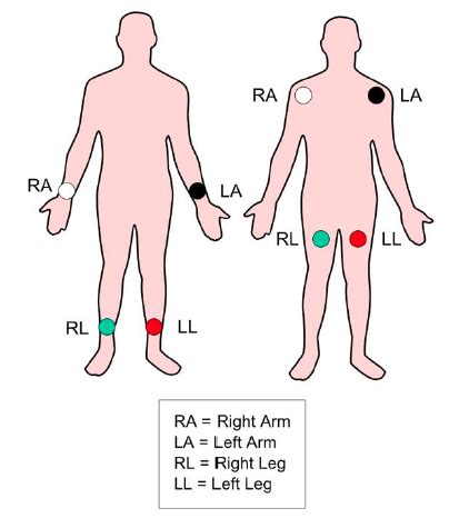 Basic Ecg Rhythm Recognition Cardiac Flashcards Quizlet