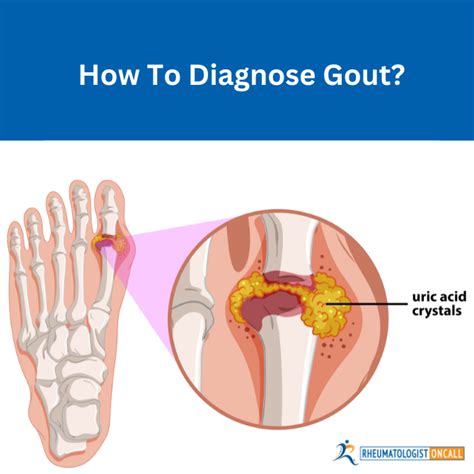 Rheumatologists Guide How To Diagnose Gout