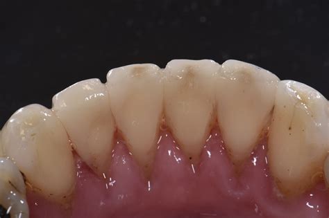 Extensive Freehand Reconstruction Of Broken Down Teeth