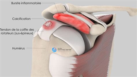 Comment Traiter La Tendinopathie Calcifiante Du Supra Pineux Sans