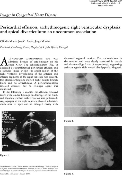 Pericardial Effusion Arrhythmogenic Right Ventricular Dysplasia And